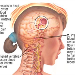 Migraine Society - Migraine Headaches Hurt! Get Help!