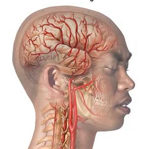 Migraine And Dehydration - How To Tell The Differences Among Different Types Of Migraines?